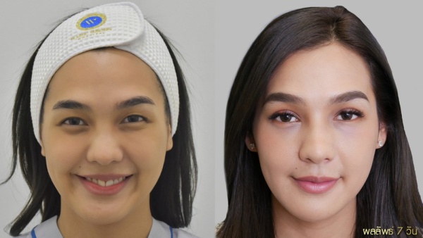 การทำศัลยกรรมตาสองชั้น