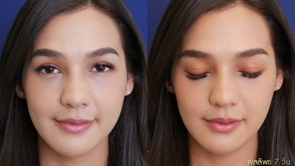 การทำศัลยกรรมตาสองชั้น