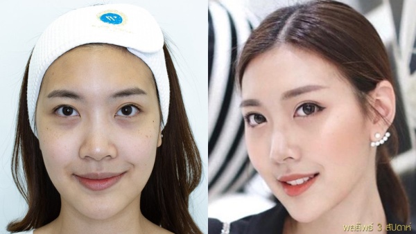 การทำศัลยกรรมตาสองชั้น