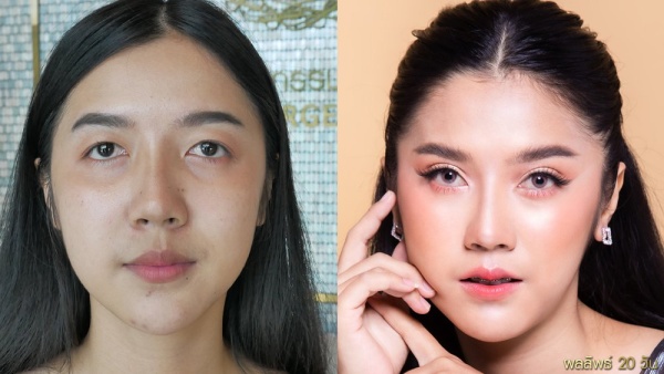 การทำศัลยกรรมตาสองชั้น