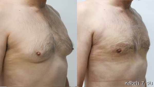 ลดขนาดหน้าอกผู้ชาย
