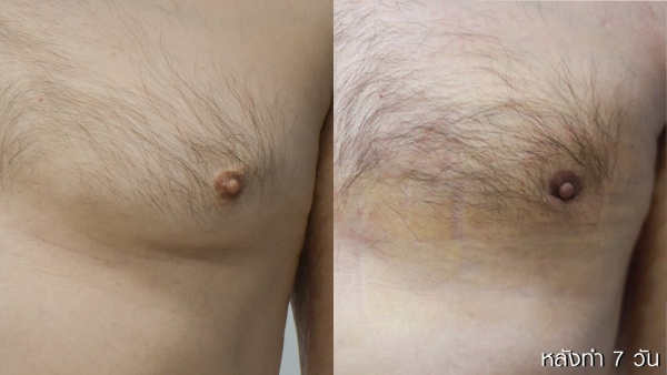 ลดขนาดหน้าอกผู้ชาย