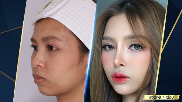 เสริมจมูก