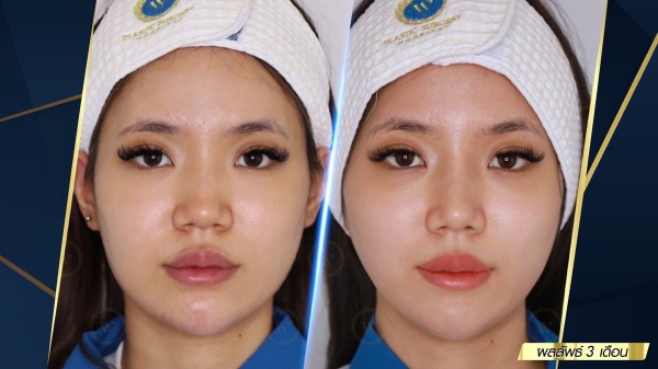 เสริมจมูก