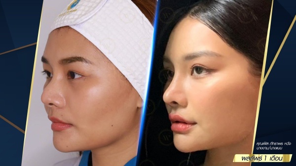 เสริมจมูก