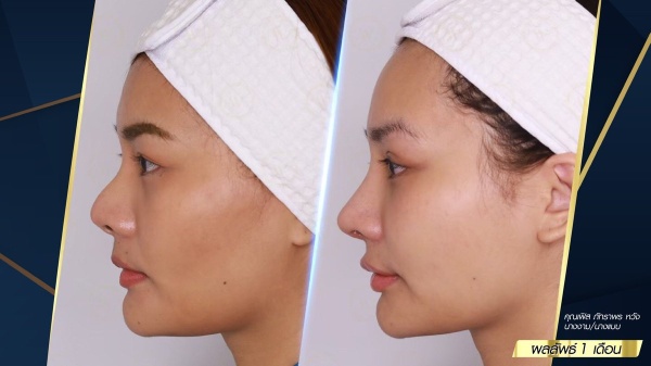 เสริมจมูก