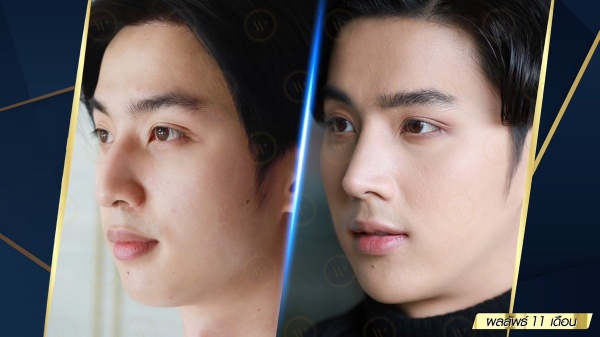 เสริมจมูก