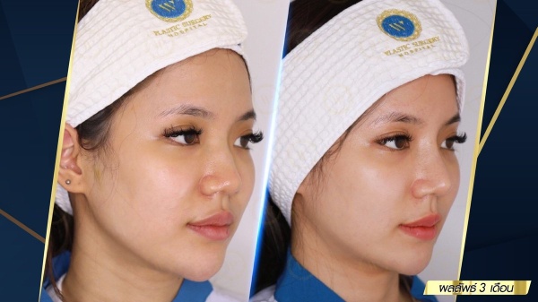 เสริมจมูก