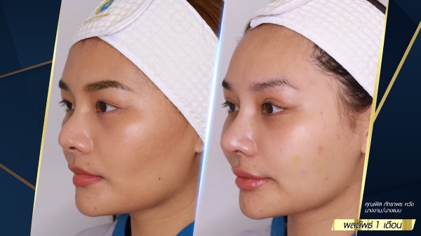 เสริมจมูก