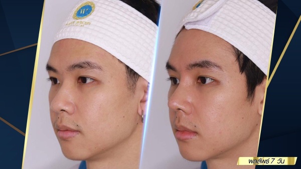 เสริมจมูก