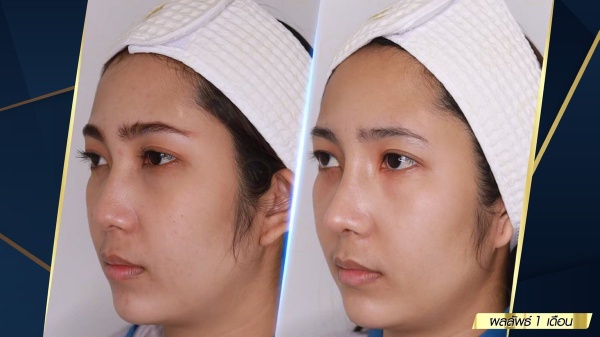 เสริมจมูก