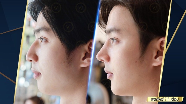 เสริมจมูก