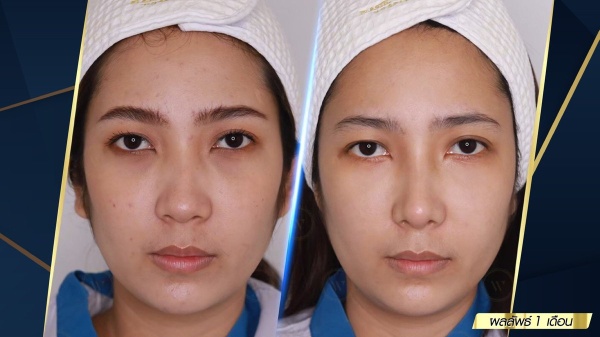 เสริมจมูก