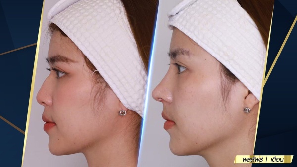 เสริมจมูก