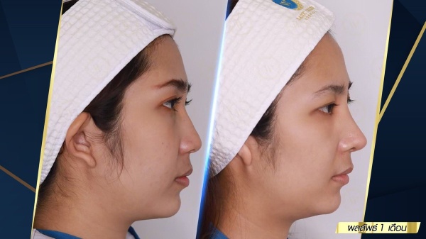 เสริมจมูก