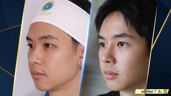 เสริมจมูก