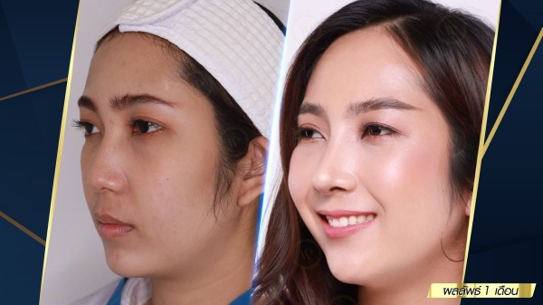 เสริมจมูก