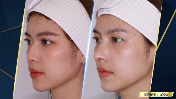 เสริมจมูก