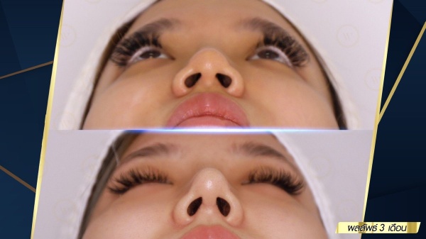 เสริมจมูก