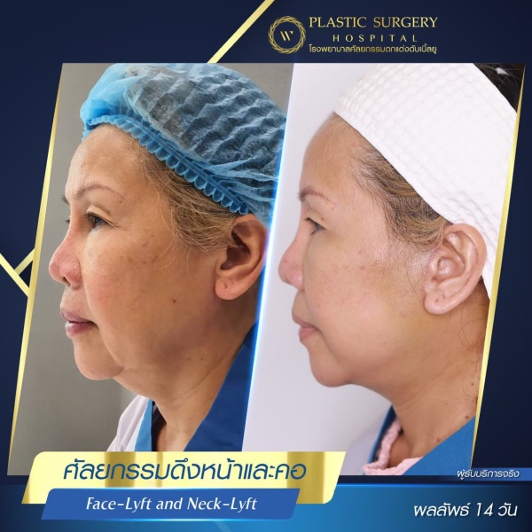 ดึงหน้า