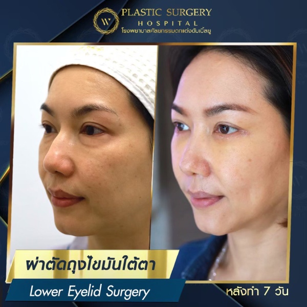 ตัดถุงไขมันใต้ตา