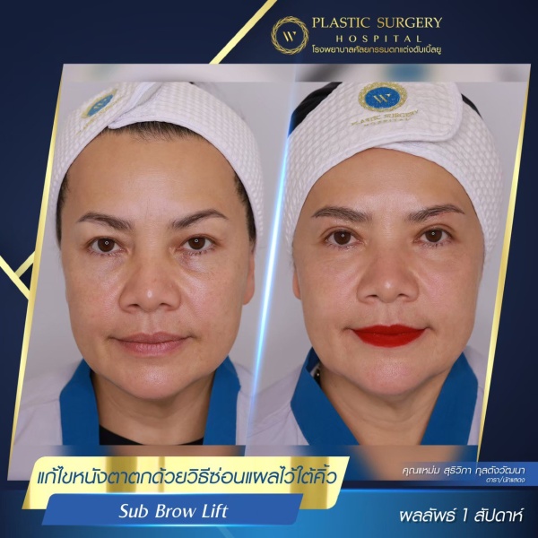 หนังตา/หางตาบนตก