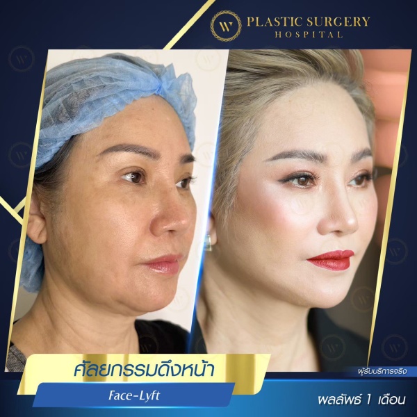 ดึงหน้า