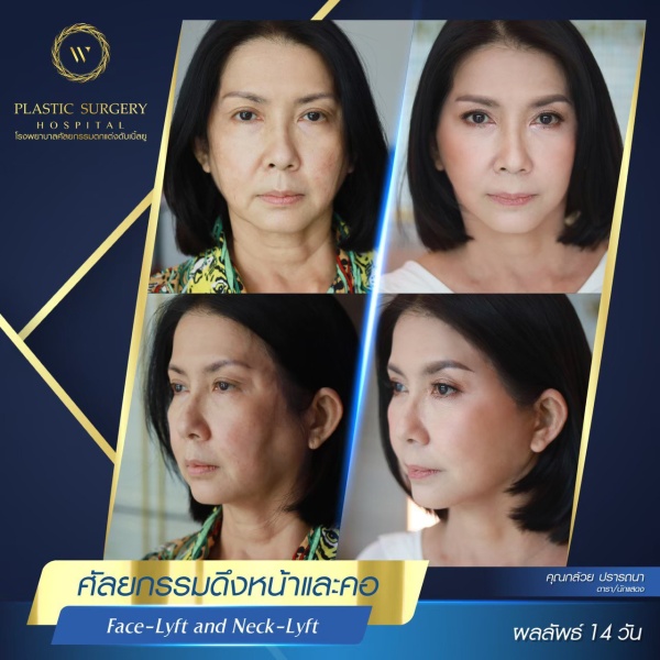 ดึงหน้า