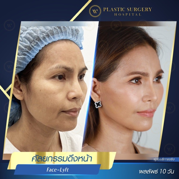 ดึงหน้า