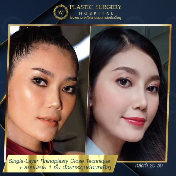 เสริมจมูก