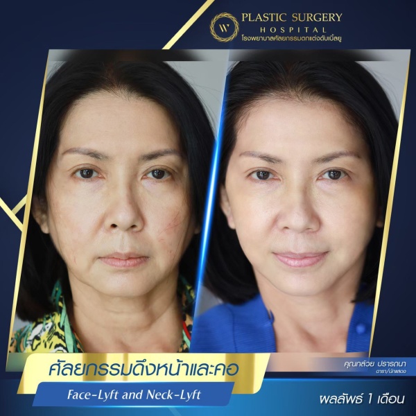 ดึงหน้า