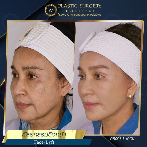 ดึงหน้า