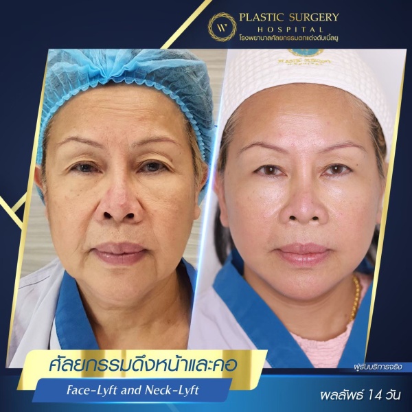 ดึงหน้า