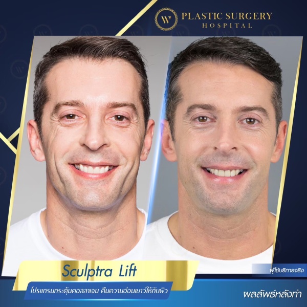 Sculptra Lift