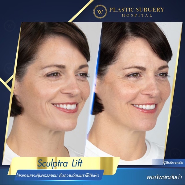 Sculptra Lift