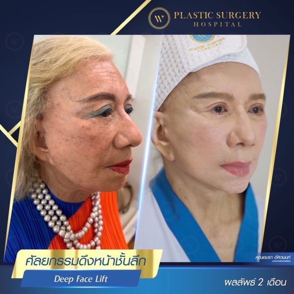 ดึงหน้า