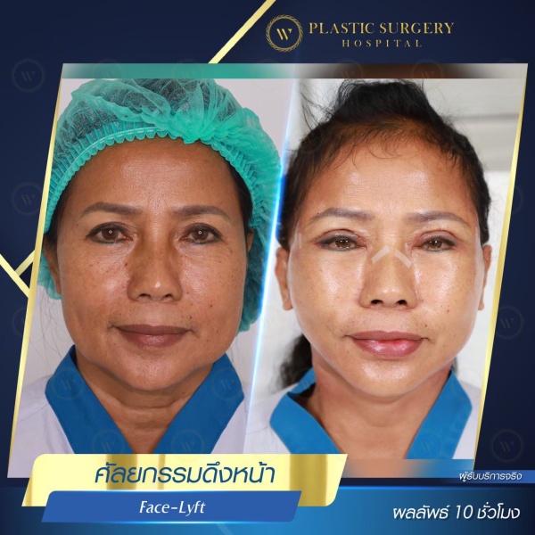 ดึงหน้า