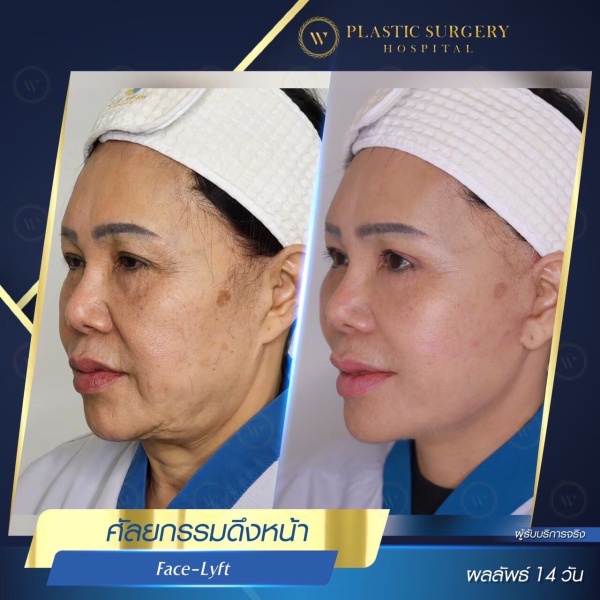 ดึงหน้า