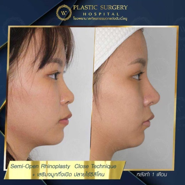 เสริมจมูก