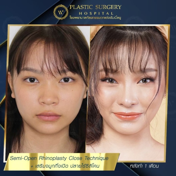 เสริมจมูก