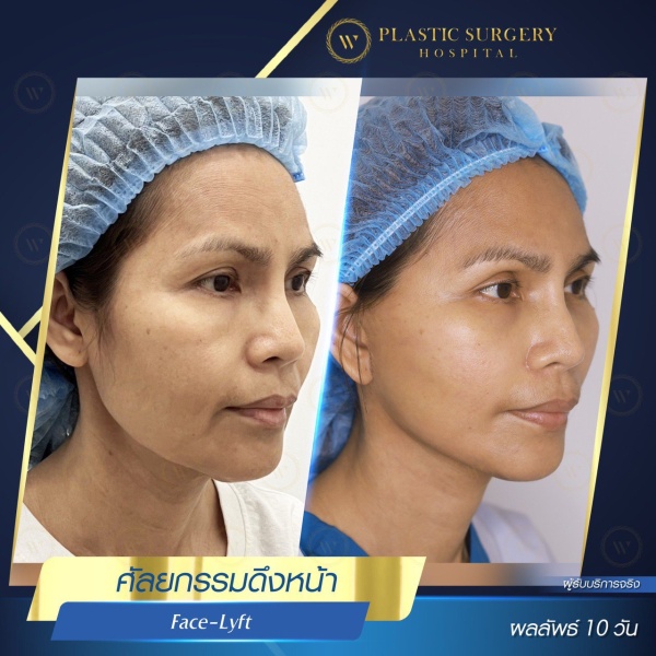 ดึงหน้า