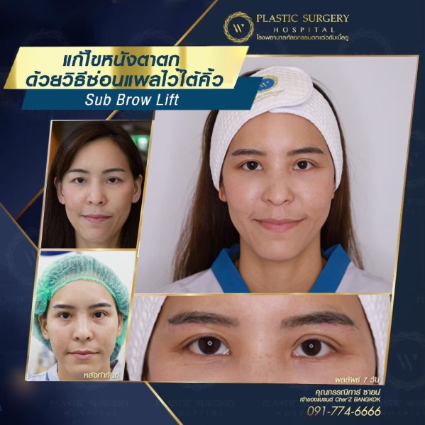 หนังตา/หางตาบนตก