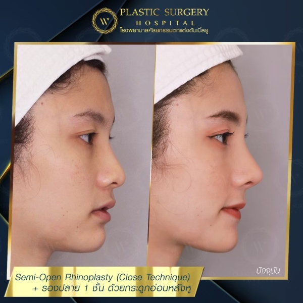 เสริมจมูก