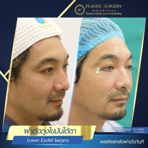ตัดถุงไขมันใต้ตา
