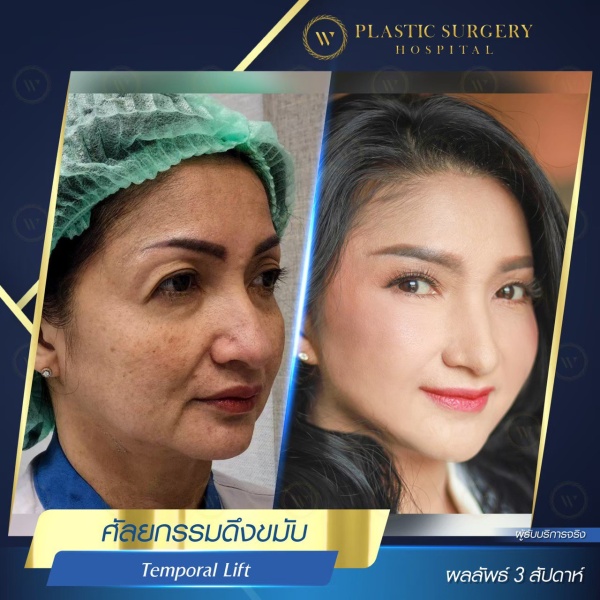 ดึงหน้า