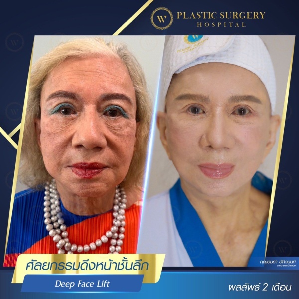 ดึงหน้า