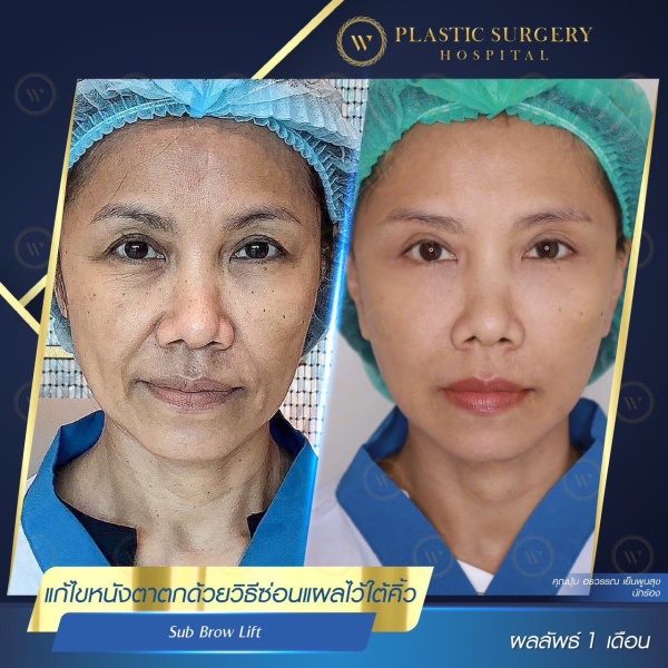 หนังตา/หางตาบนตก