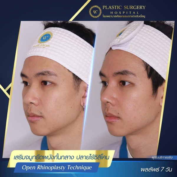 เสริมจมูก