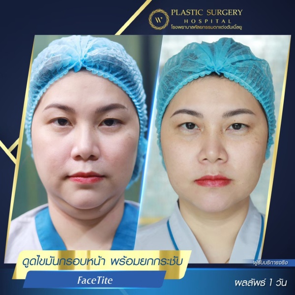 ดูดไขมันเหนียงใต้คาง (FaceTite)