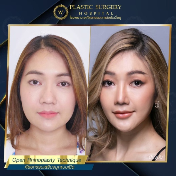 เสริมจมูก